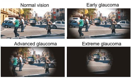 Street scene as seen with normal vision, early glaucoma, advanced glaucoma and extreme glaucoma